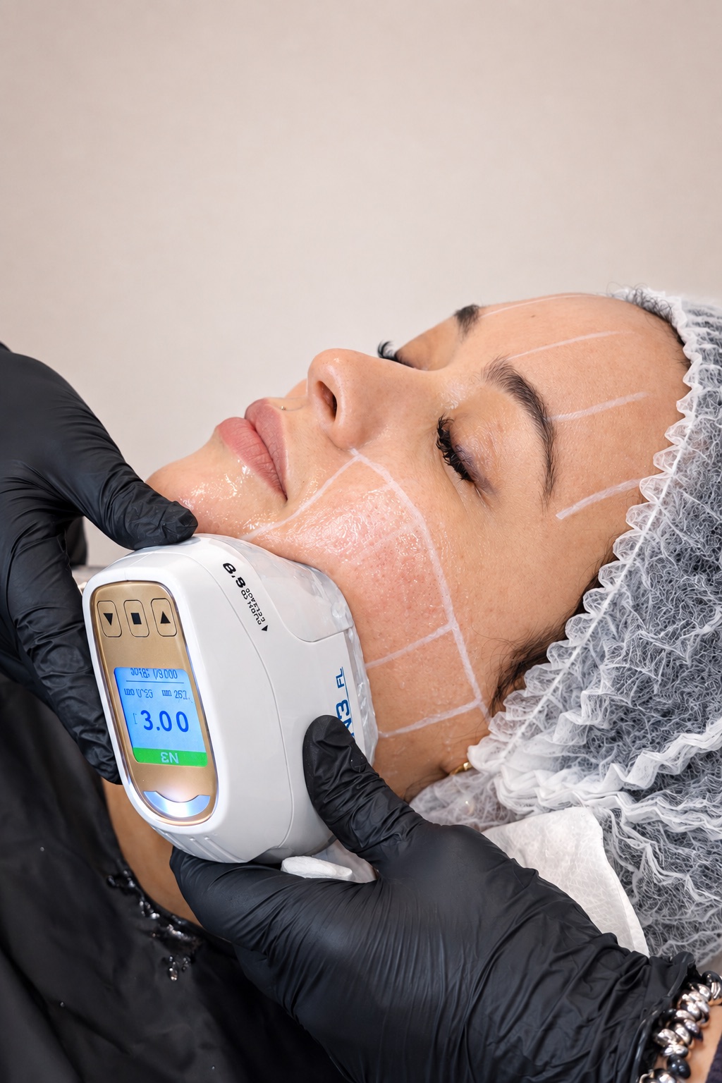 Aplicación de UltraLift en el óvalo facial