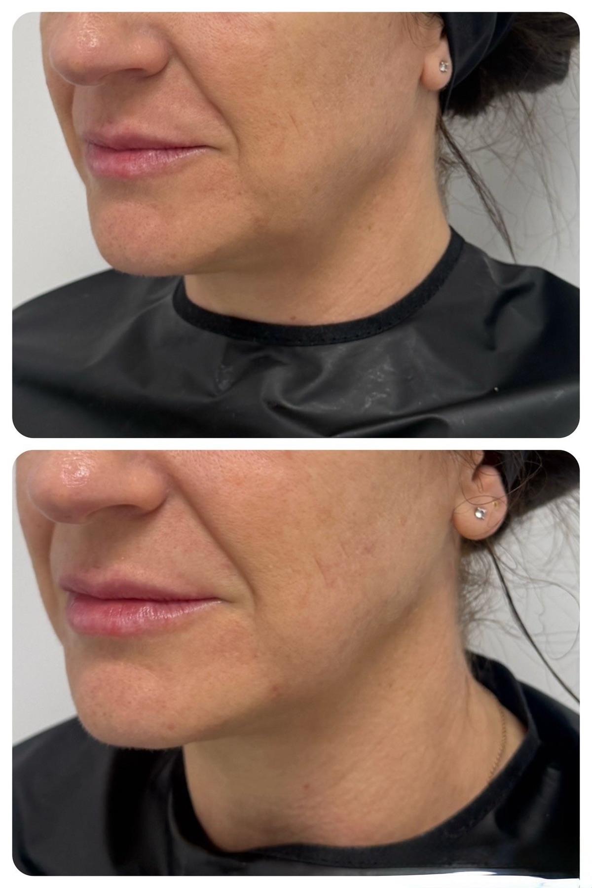 Antes y después del contorno mandibular con UltraLift