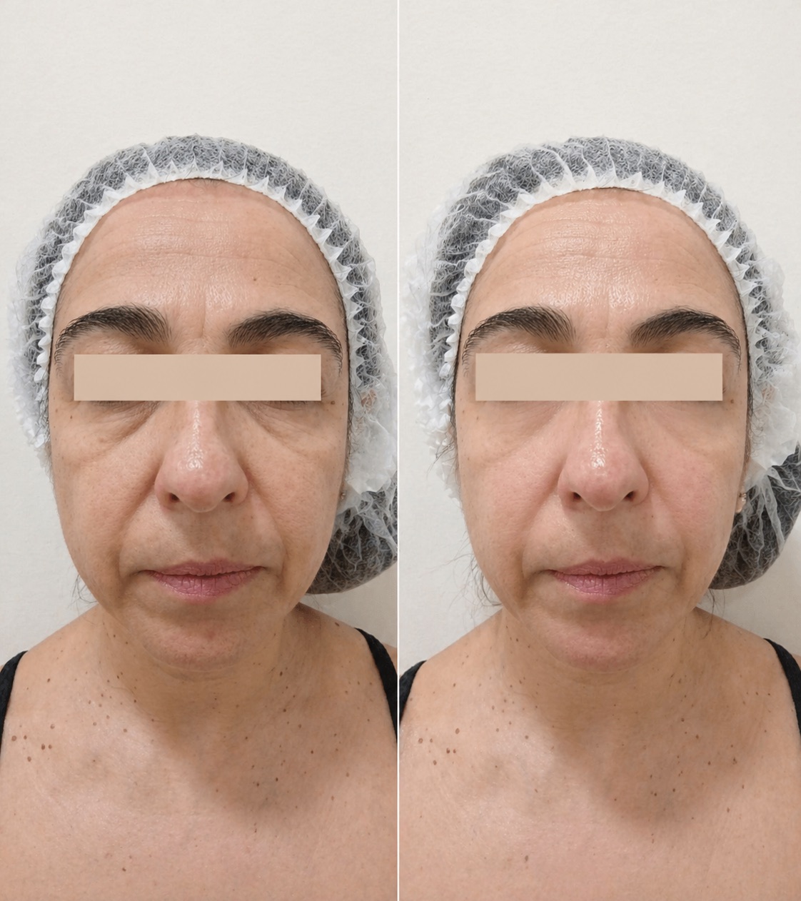 Antes y después de Elsa Señor tras el protocolo Reversa
