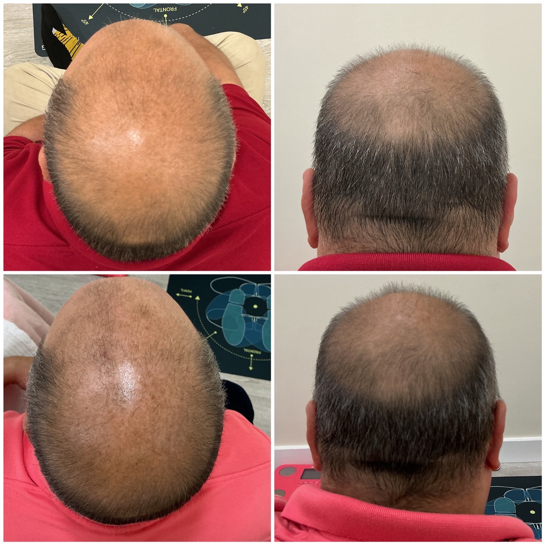 Evolución capilar con Hair Density, estudio CHEBAI en curso